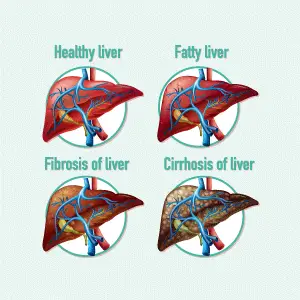 4 stadia van leverziekte