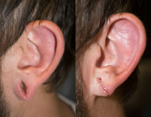 Ear gauge reparatie