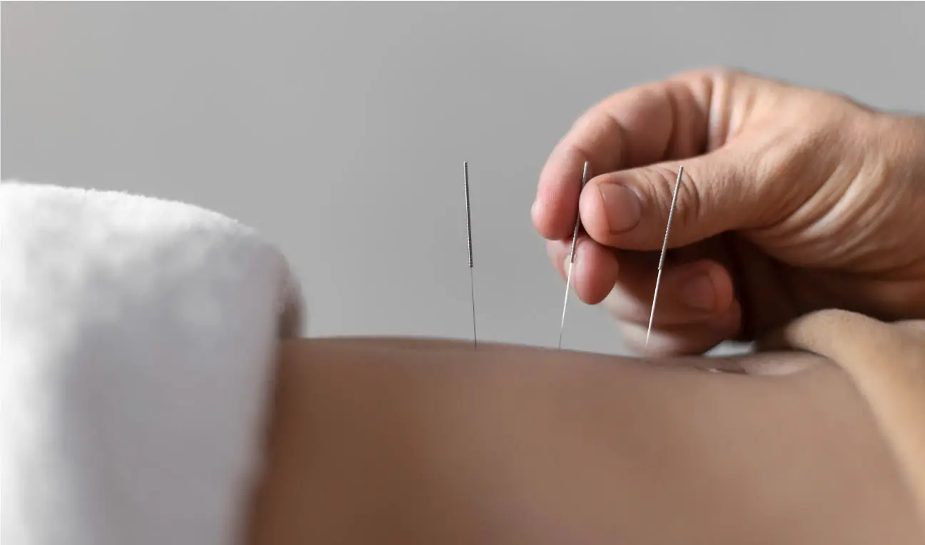 man plaatst acupunctuur naalden