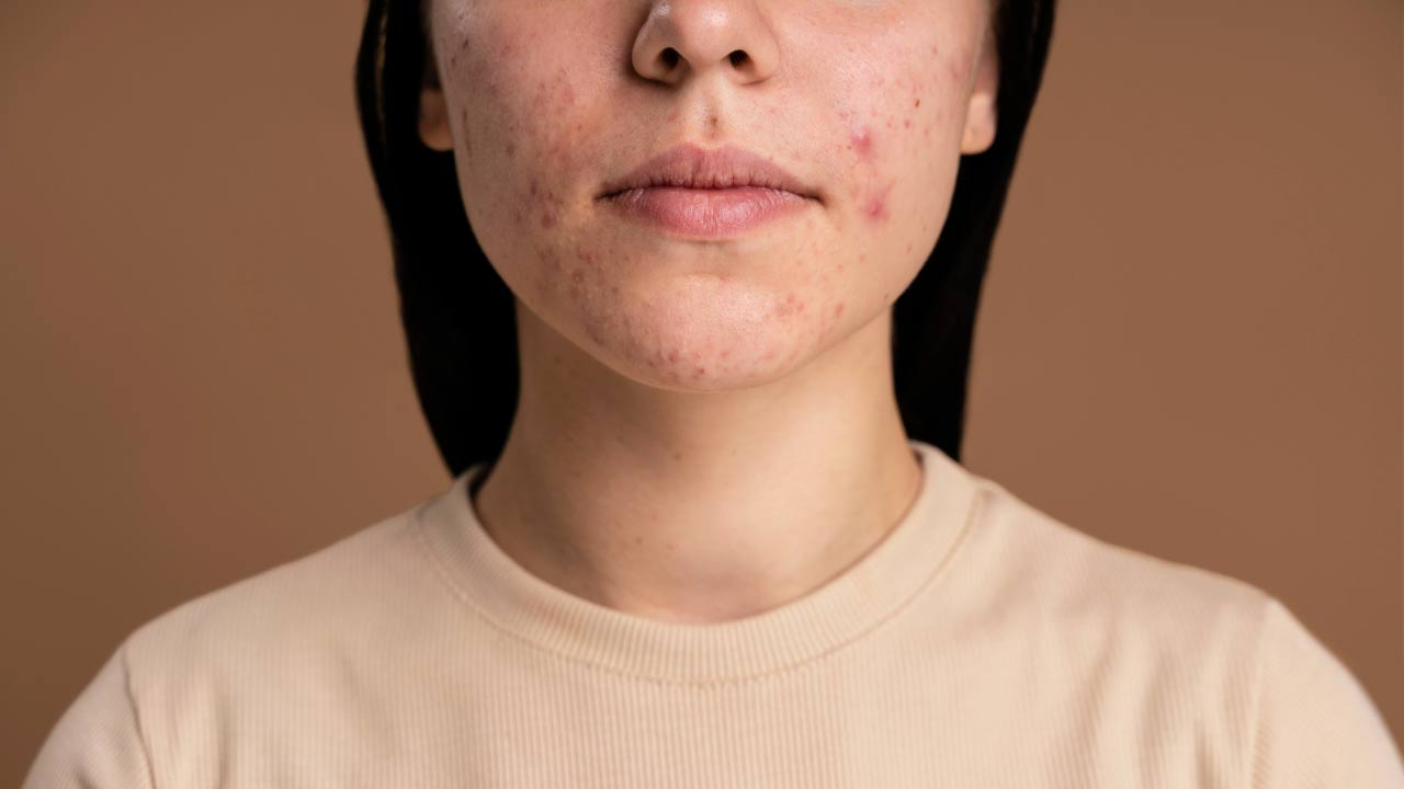 jonge vrouw met acne
