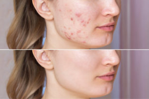 vrouwen gezicht met en zonder acne