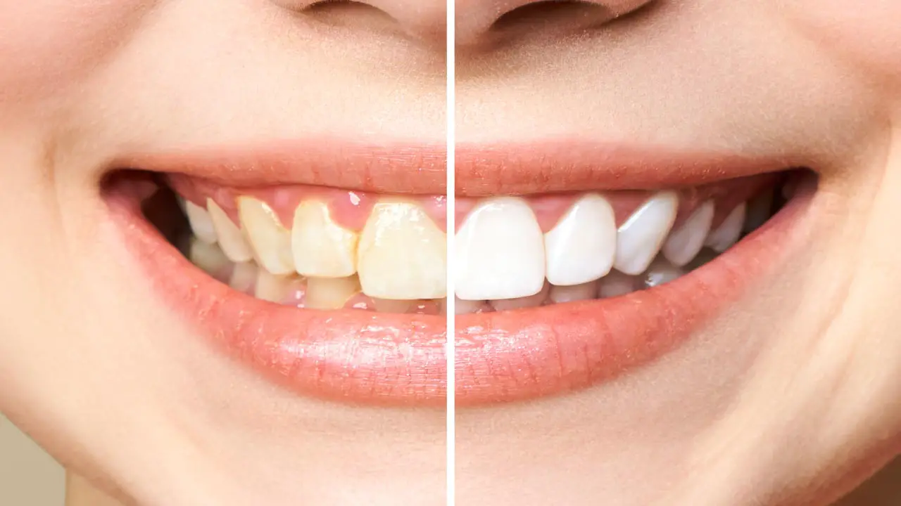 voor en na tanden bleken