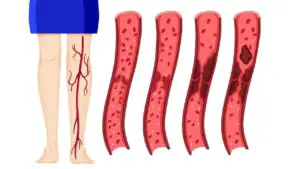 bloedvaten trombose