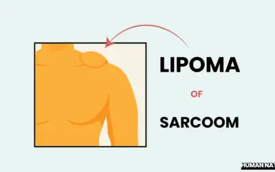 Lipoom of Sarcoom? 3 Herkenbare Verschillen