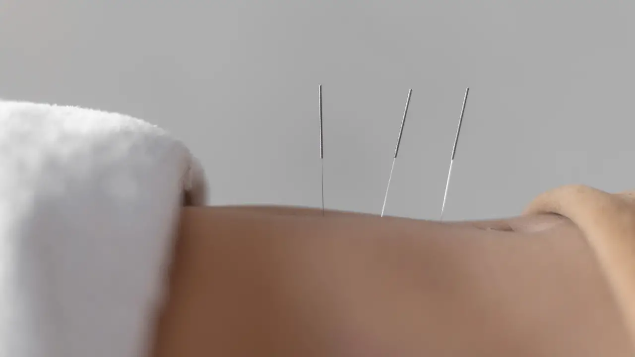 acupunctuur naalden in rug