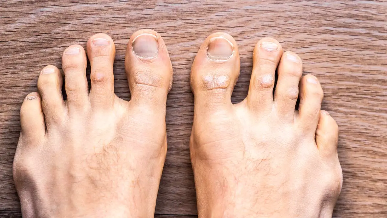 psoriasis voeten man