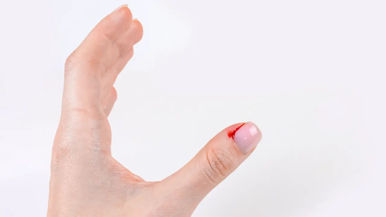 vrouw last van nagelriem